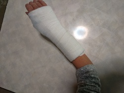 手の怪我